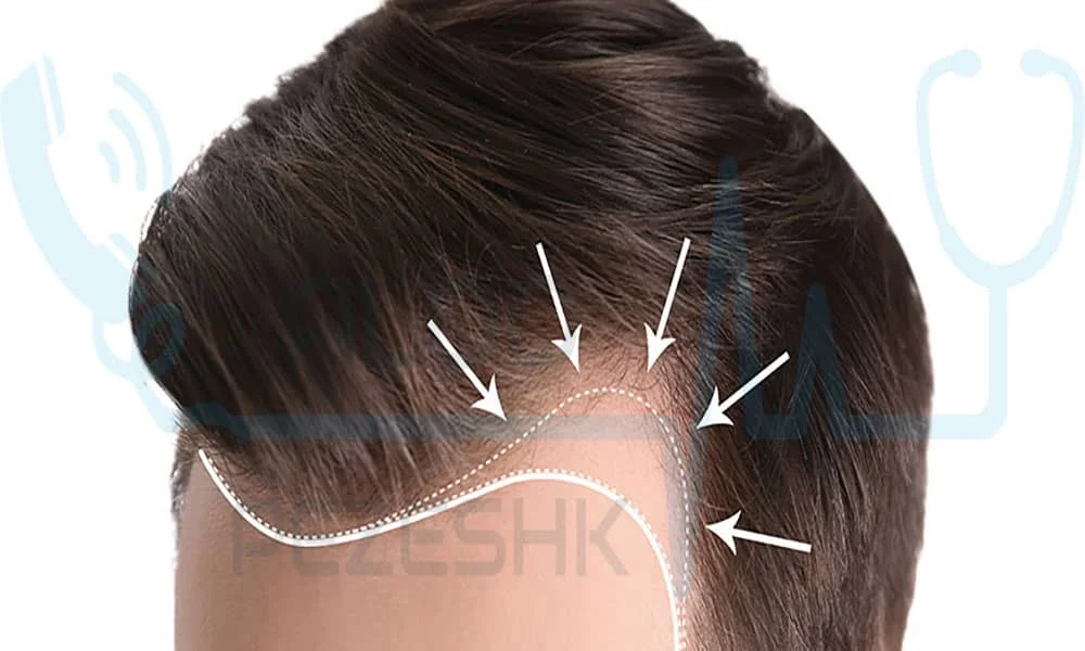 کاشت مو به روش DHI مناسب چه افرادیست