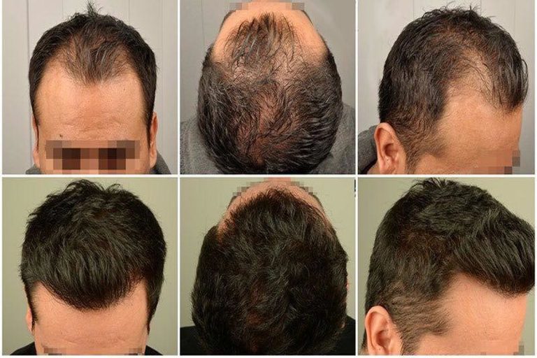 مرکز تخصصی کاشت مو رنسانس | خدمات پیشرفته کاشت مو و ترمیم موی طبیعی