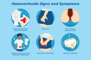 برای بواسیر پیش چه دکتری بریم؟ تغییر سبک زندگی جهت کاهش فشار روی وریدهای مقعد