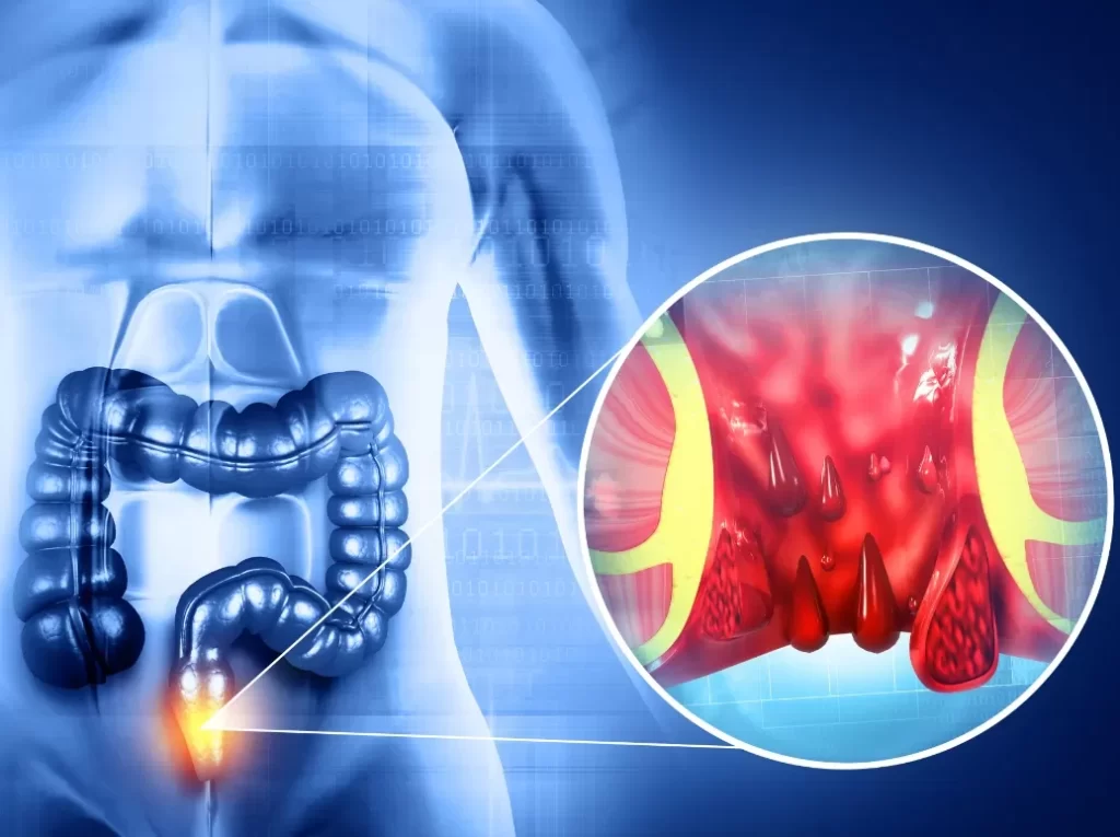 برای بواسیر پیش چه دکتری بریم؟ تغییر سبک زندگی جهت کاهش فشار روی وریدهای مقعد