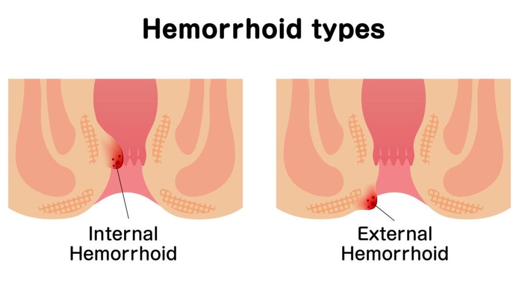 انواع بواسیر