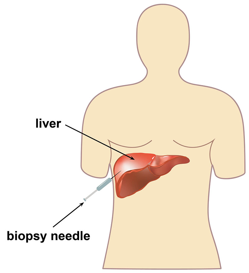 بیوپسی کبد