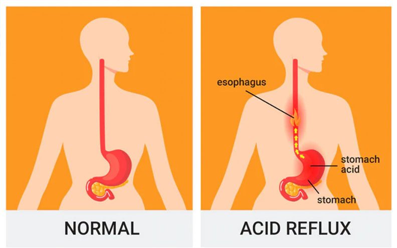 رفلاکس اسید معده؛ یکی از علل تلخی دهان