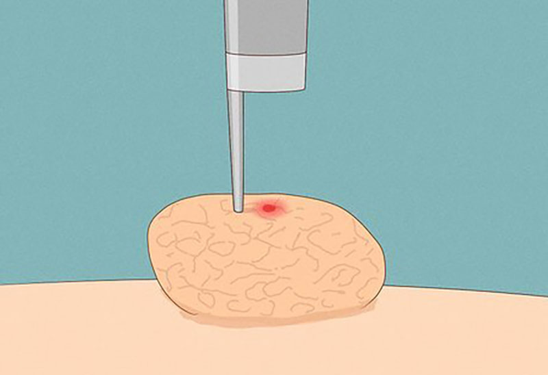 درمان زگیل تناسلی