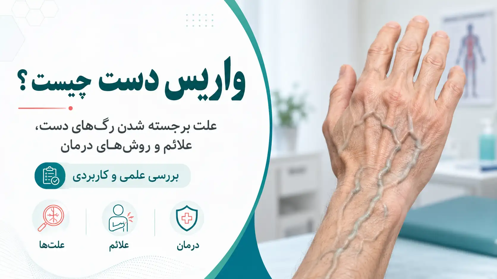 واریس دست چیست